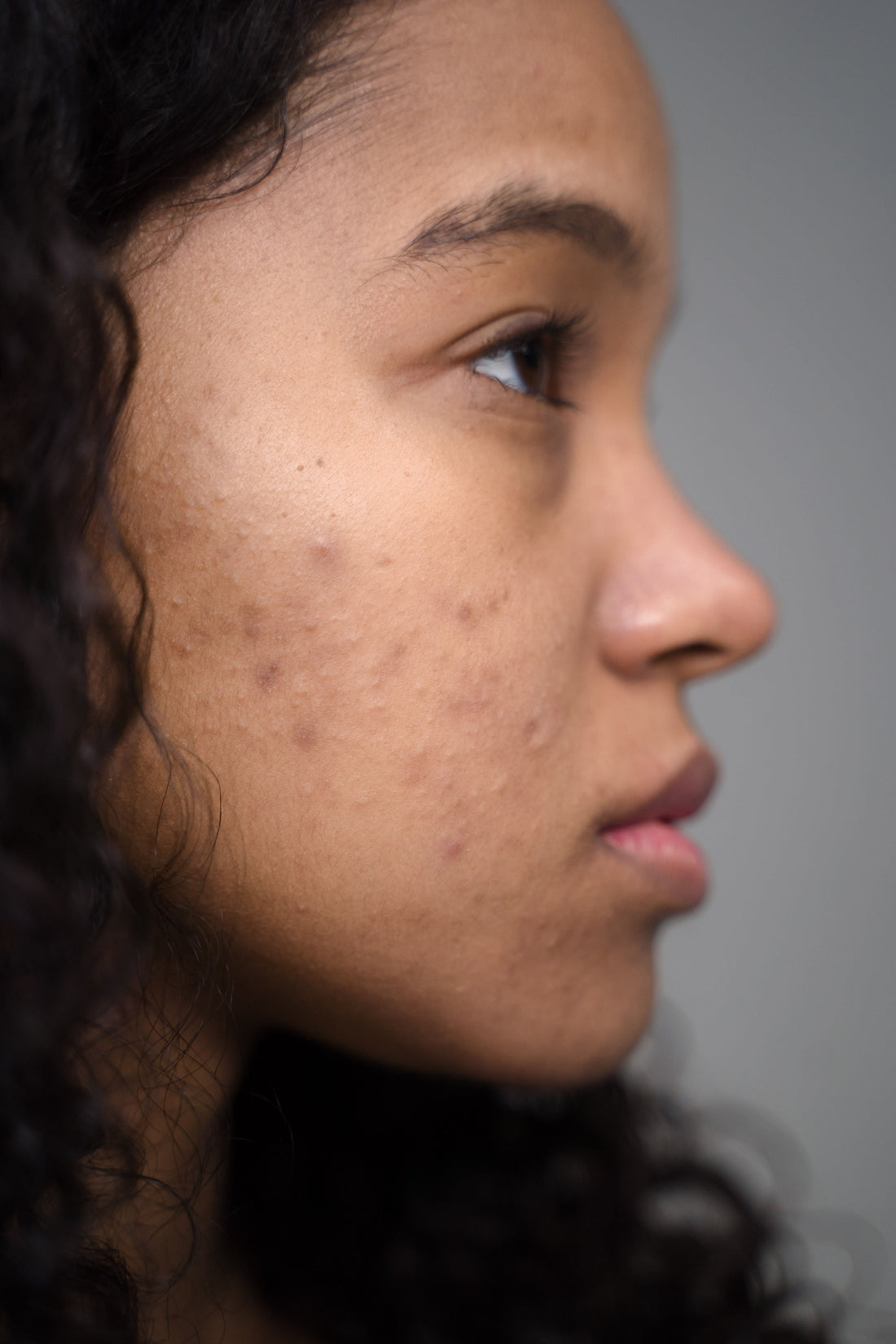 Peau grasse : pourquoi l'acide salicylique est votre allié rentrée